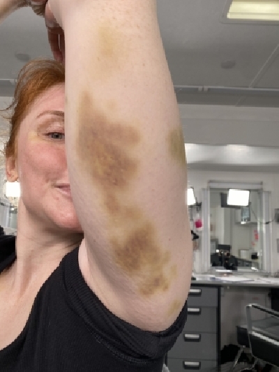 Bryce Dallas Howard bruised while filming 