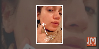 Bhumi Pednekar shares her pimple woes